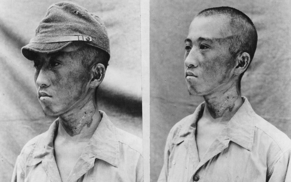 	This patient (photographed by Japanese forces on October 2nd, 1945) was about 6,500 feet from ground zero when the rays struck him from the left. His cap was sufficient to protect the top of his head against flash burns.
