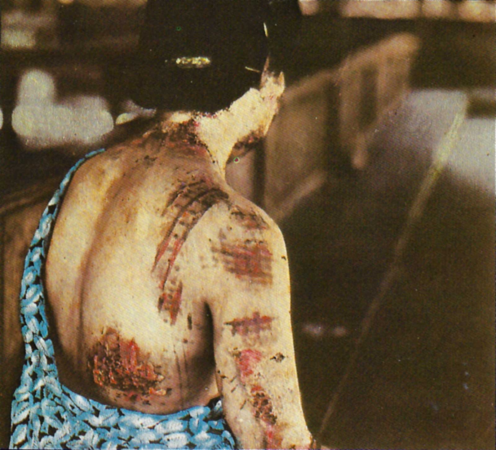 The burns are in a pattern corresponding to the dark portions of the kimono she was wearing at the time of the explosion.