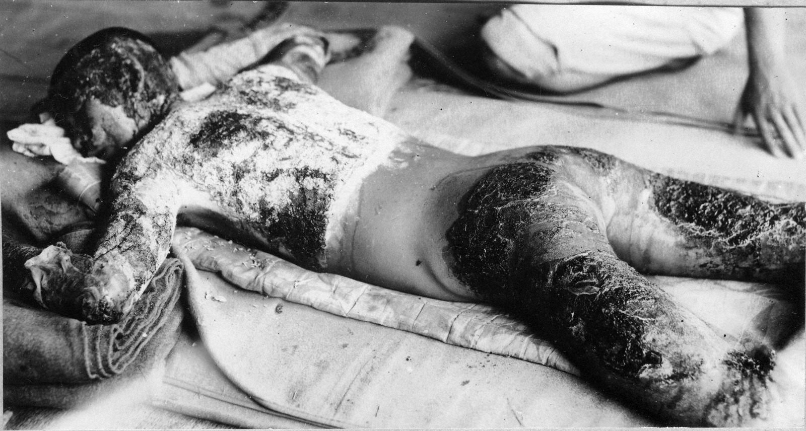 Severe Burns