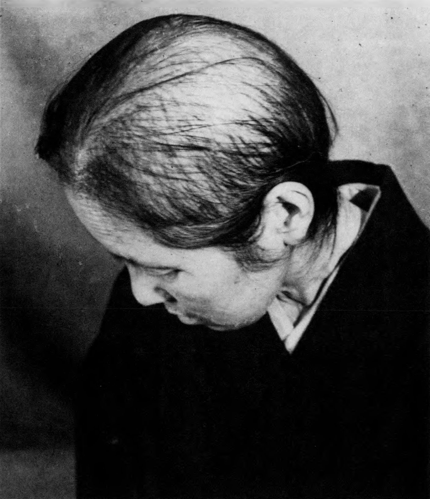 The Role Of Genetics In Post-Surgical Hair Loss